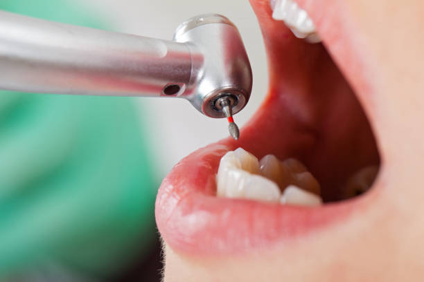 Best Emergency Treatment for Dental Infections or Abscesses in Riverside, MD